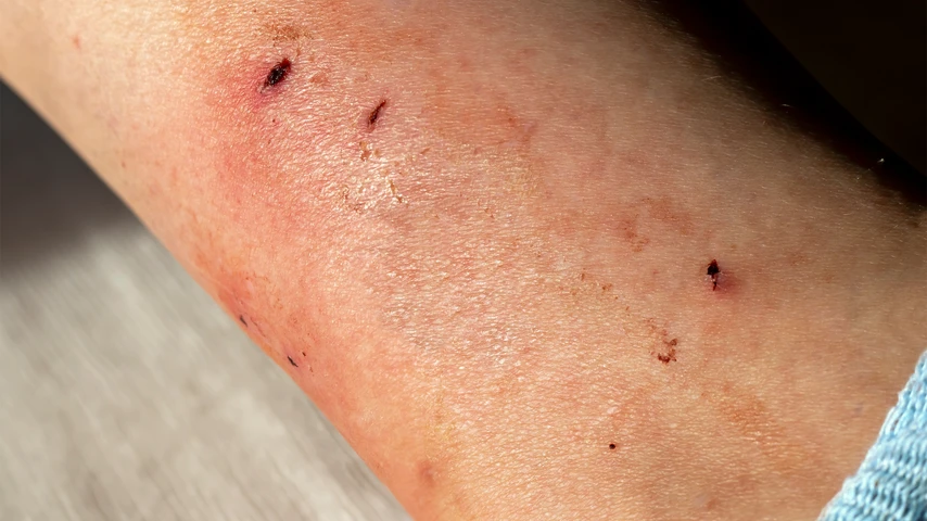 Cat bite on arm