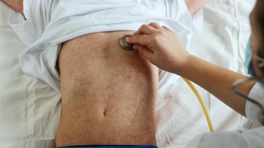 Yong boy lying on a bed with shirt raised to show measles rash, doctor listening to chest with stethescope